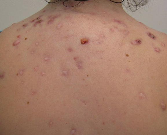 Acne on the back