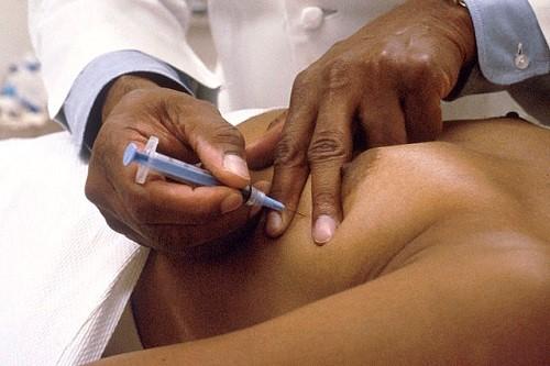 Aspiration à l'aiguille fine