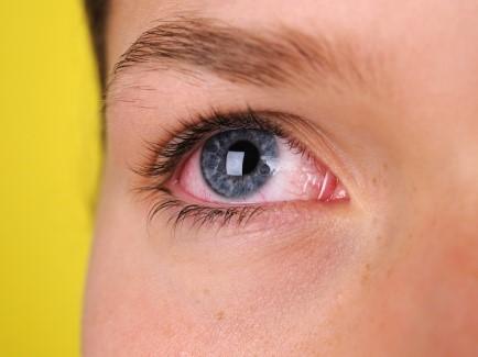 problèmes oculaires