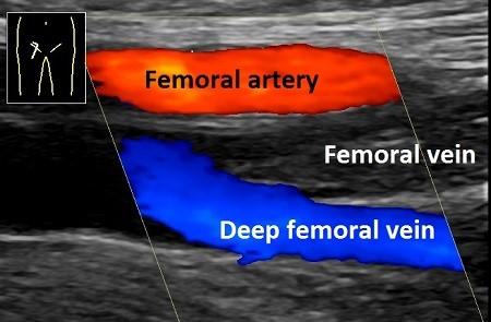 Échographie en couleurs