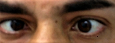 VI et XII Palsies du nerf crânien