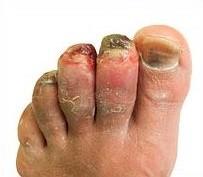 Gelure - blessure initiale