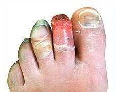 Gelures 12 jours après la blessure