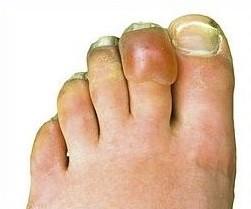 Blessures par gelures après trois semaines