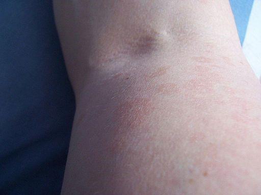 Pityriasis versicolor gros plan