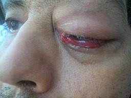 Cellulite périorbitaire