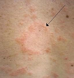 Pityriasis rosea héraut