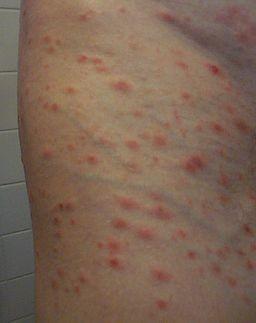 Pityriasis lichenoides et varioliformis acuta