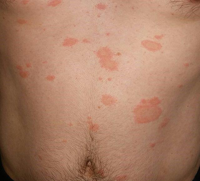 pityriasis rosea photos
