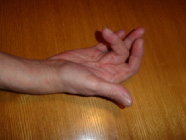 Contracture de Dupuytren