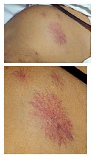 Naevus de l'araignée