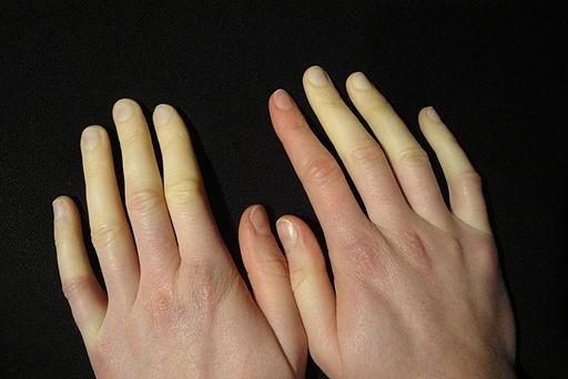 Maladie de Raynaud