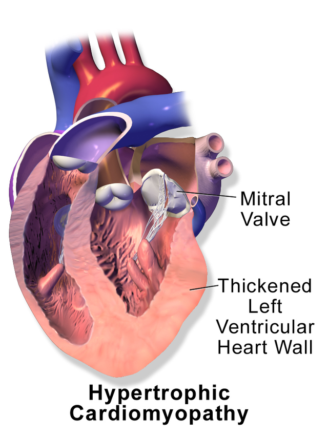 Cardiomyopathie hypertrophique