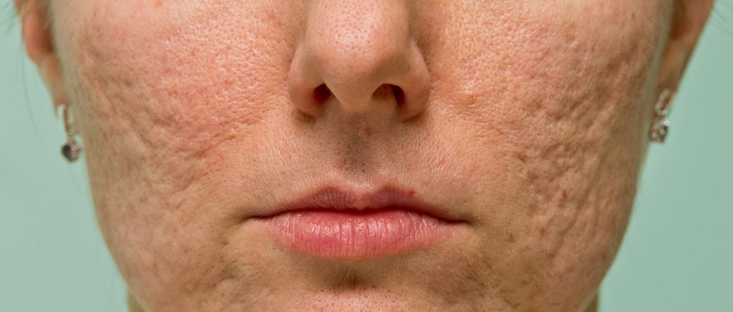 Bio-Oil aide-t-il à atténuer les cicatrices d'acné ?