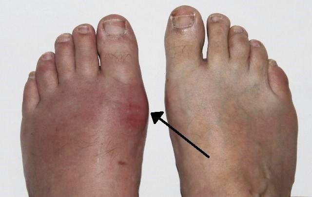 Gout - podagra