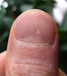 Psoriasis des ongles