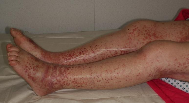 Purpura de Henoch-Schönlein