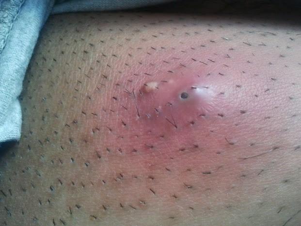 Abcès de cinq jours