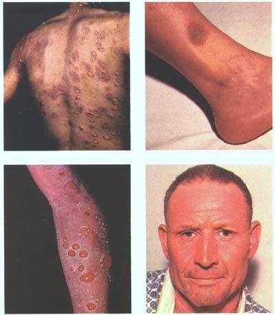 Éruptions médicamenteuses