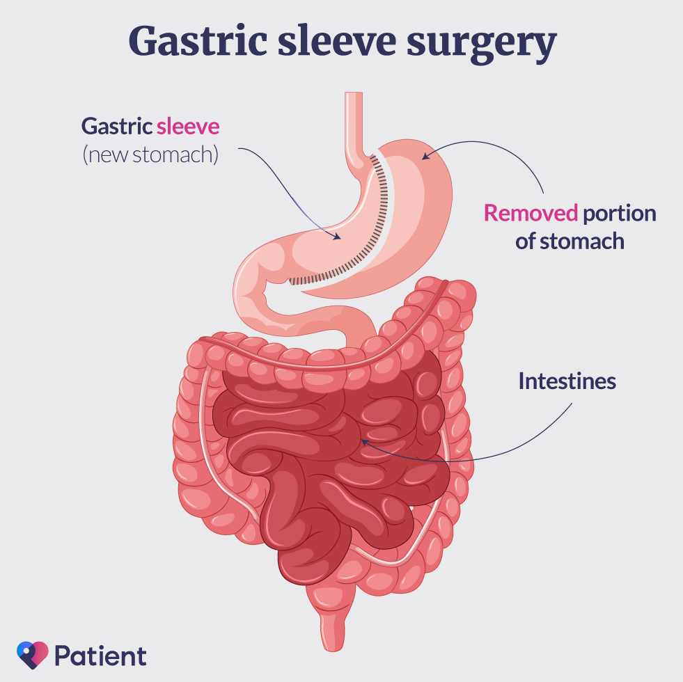 Chirurgie de la sleeve gastrique
