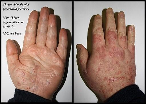 Psoriasis des mains