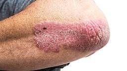 Psoriasis en plaques