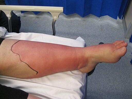 Cellulite sur la jambe (Wikimedia Commons)